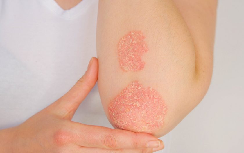 psoriasis