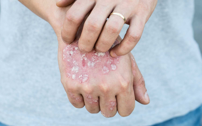 psoriasis