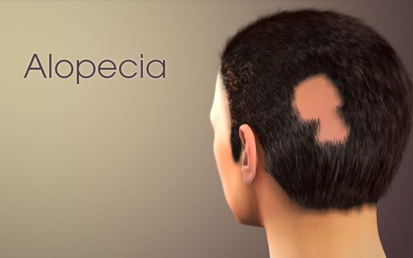 alopecia