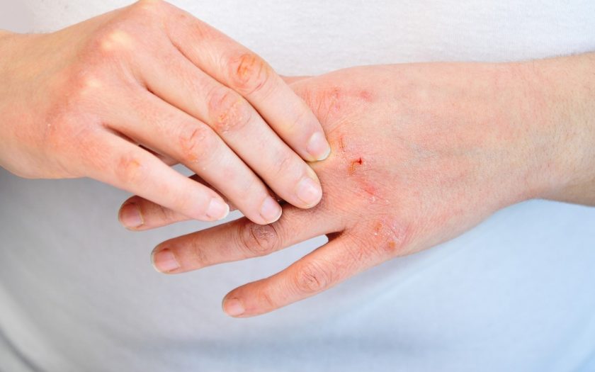 eczema