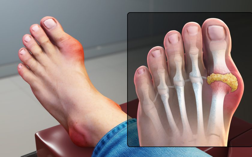 gout